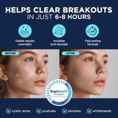 Hydrocolloid Pimple Patches (134 Count) - Blemish Spot Covers for Face - Creatique